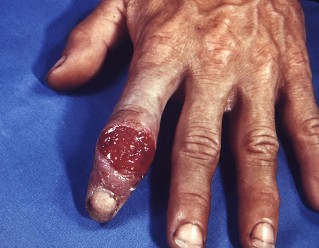 Syphilis of the hands