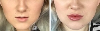 Thin Upper Lip Transformed with 1ml