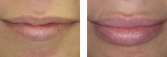 Height and Volume Increase With Lip Filler