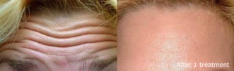 Forehead Botox Treatment