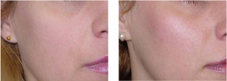 Cheek filler works instantly and givess a youthful mid face.
