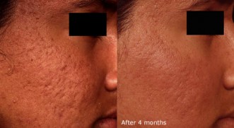 Visibly reduced pock marks after treatment.
