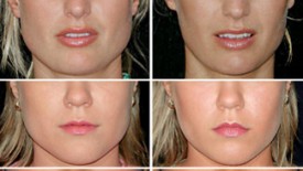Botox for Jaw Muscle