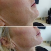 Jawline Definition With Filler